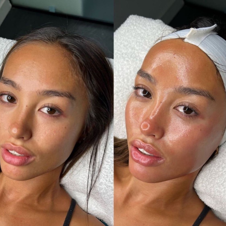 ENDOLIFT ET ACIDE HYALURONIQUE